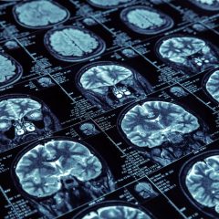 An algorithm developed at McGill allows early detection of Alzheimer’s disease
