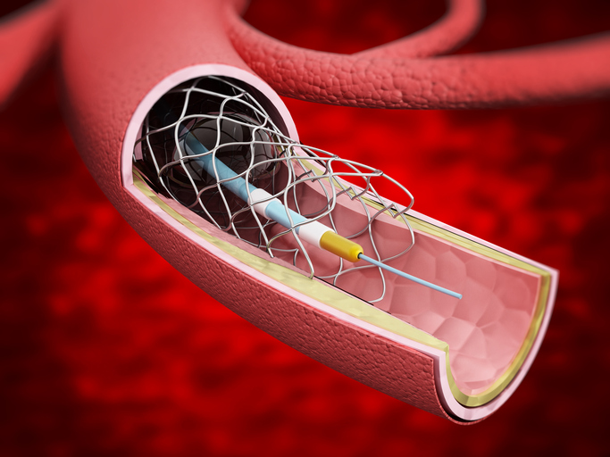 Detailed illustration showing vascular stent inside the vein.